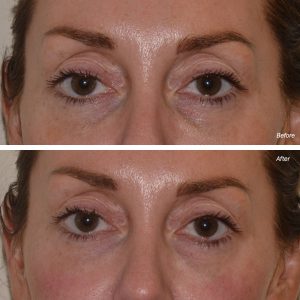 dermal filler tear trough under eye injections before after photo