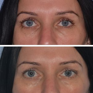 dermal filler tear trough under eye injections before after photo