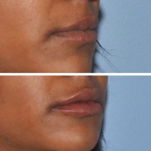 dermal lip filler injections before after