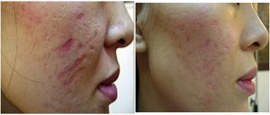 dermaroller acne scars before after photo