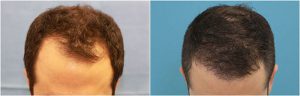 dr reddy fue hair transplant before after photo