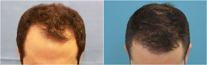 FUE hair transplant to fix receding hairline and temples, Hair Restoration  Surgery