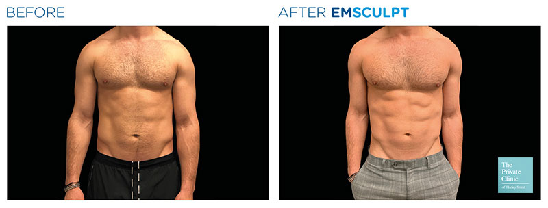 Muscle Building non-surgical treatment UK, Abs Sculpting EmSculpt