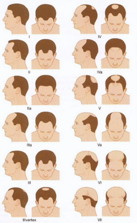 The Private Clinic: Norwood chart