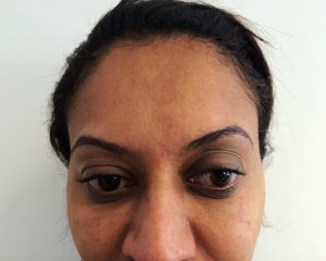 eyebrows-fue-hair-transplant-after