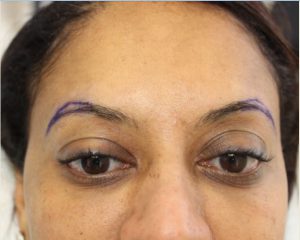 eyebrow-outline-before-hair-transplant