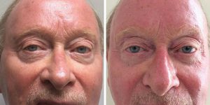 eyelid surgery before and after photo