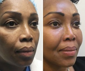 face fat transfer before and after photo UK