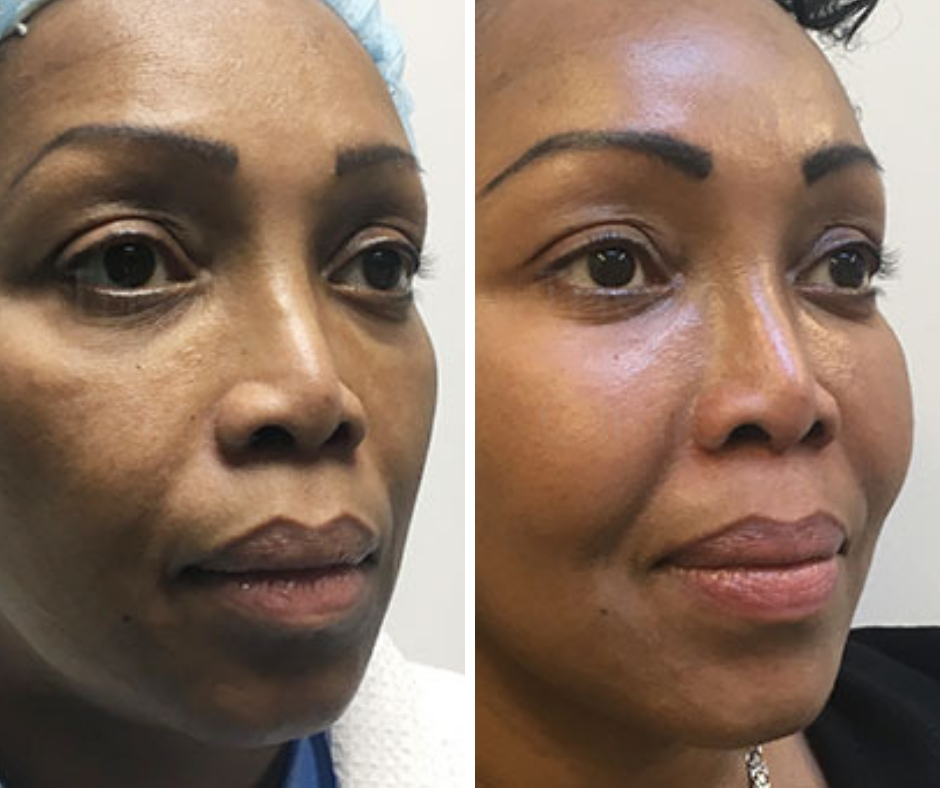 Non-Invasive Facial Contouring Procedures