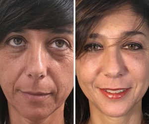 face fat transfer results before after photo