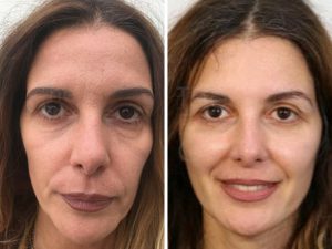 facelift before and after photo london