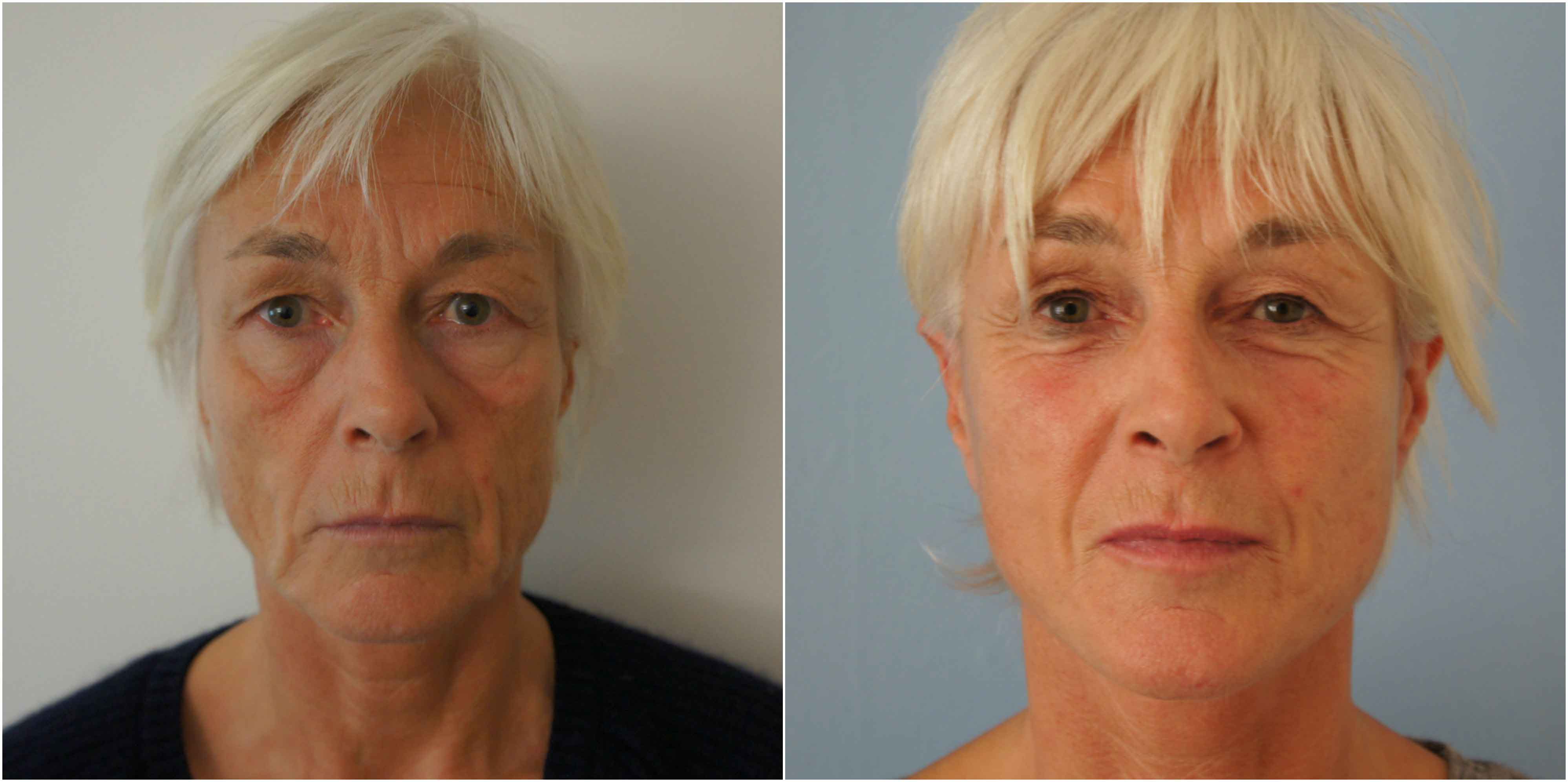 Mini Facelift Before and After Photo UK