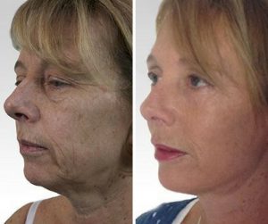 facelift surgery before and after photo UK