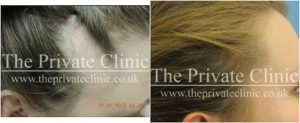 female-hair-transplant-before-after-1-the-private-clinic