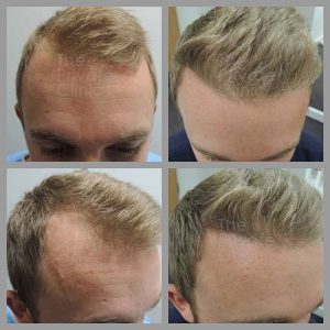 fue hair transplant before after photos