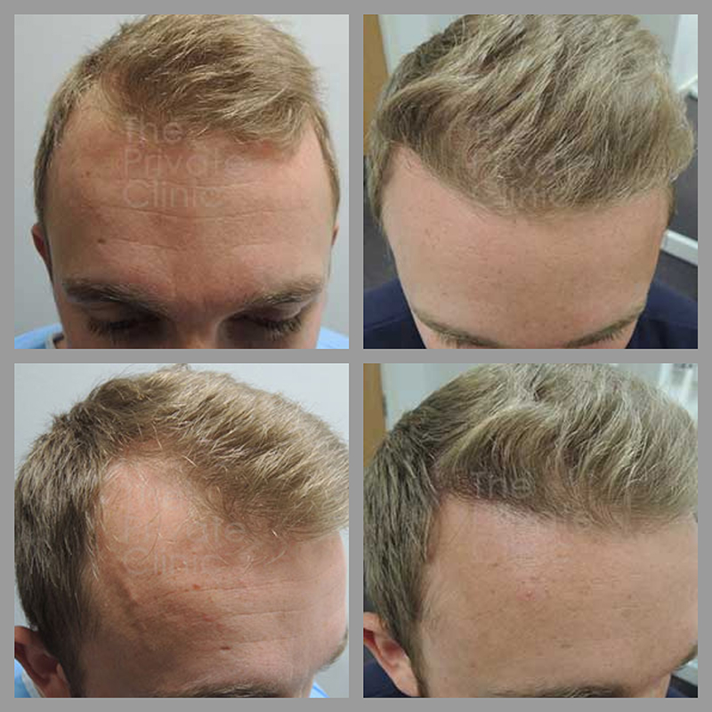 Bangladesh Hair Transplant Before After Results