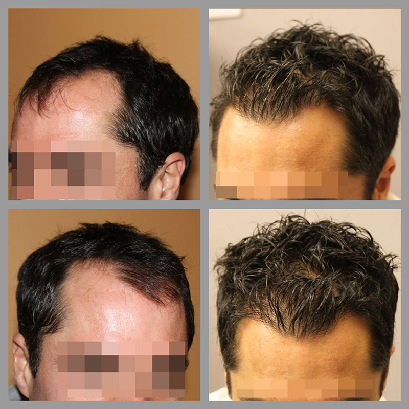 Hair Transplant Near Me | The Private Clinic
