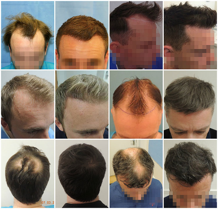 Hair Transplant Results 6-months post op, After hair transplant hair growth