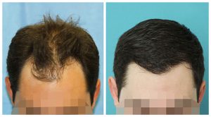 fue hair transplant before after photo temple results