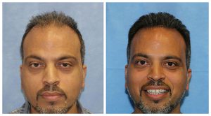 fue hair transplant before after results crown area