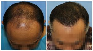 hair transplant crown temple area before after photo