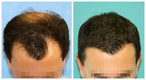 male hair transplant before after photo