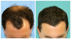 fue hair transplant before after results