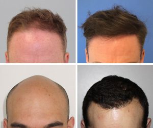 FUE Hair Transplant method before and after The Private Clinic