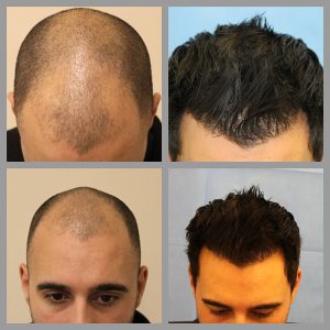 fue hair transplant frontal mid scalp anterior areas 2307 grafts before after photos