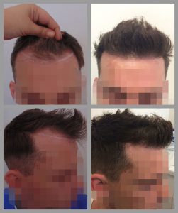 fue hair transplant hairline area 2000 hairs before after photos