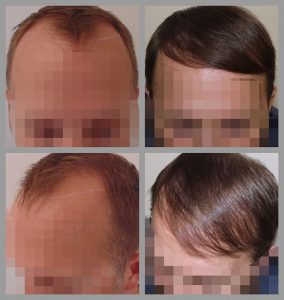 fue hair transplant hairline area before after photos