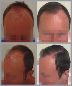 fue hair transplant hairline temples areas 3500 hairs before after photos