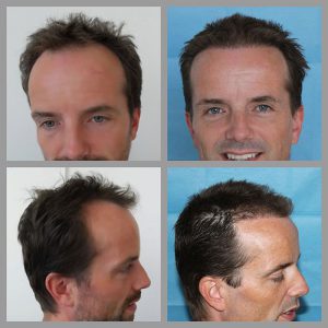 fue hair transplant hairline temples frontal areas 1112 grafts before after photos