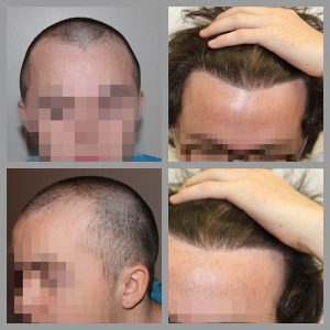 fue hair transplant mid scalp anterior frontal hairline areas treated 1020 grafts before after photos