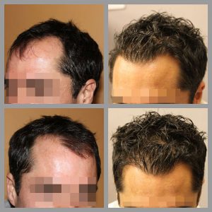 fue hair transplant mid scalp vertex temples areas treated 1200 grafts before after photos