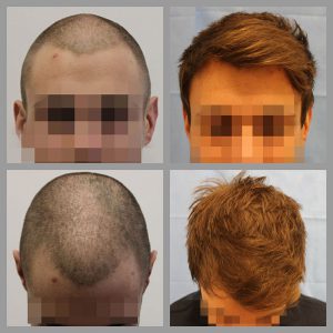 fue hair transplant mid scap anterior frontal hairline areas 800 grafts before after photos