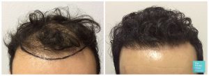 FUE hair transplant crown area before and after photo