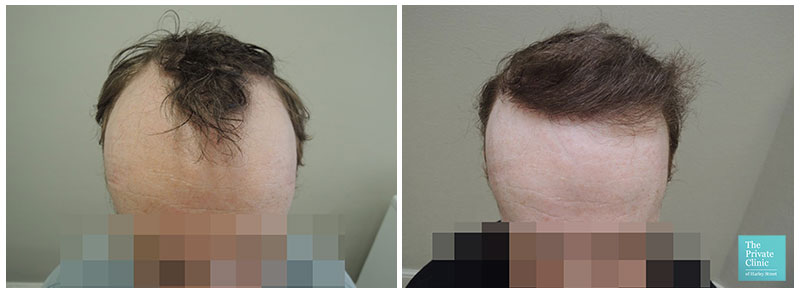 hair transplant restoration hairline before after photo