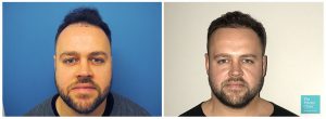 hair transplant hairline restoration before after photo results