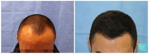 fue hair transplant restoration hairline before after photos