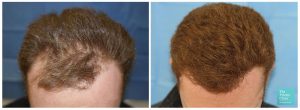 FUE hair transplant temples top area before and after photo