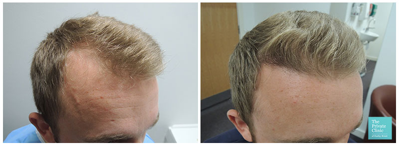 Perfect Age Limit for Hair Transplant in Guwahati  DHI India  Paperblog