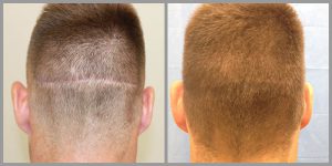 fue hair transplant scar repair 207 grafts before after photos