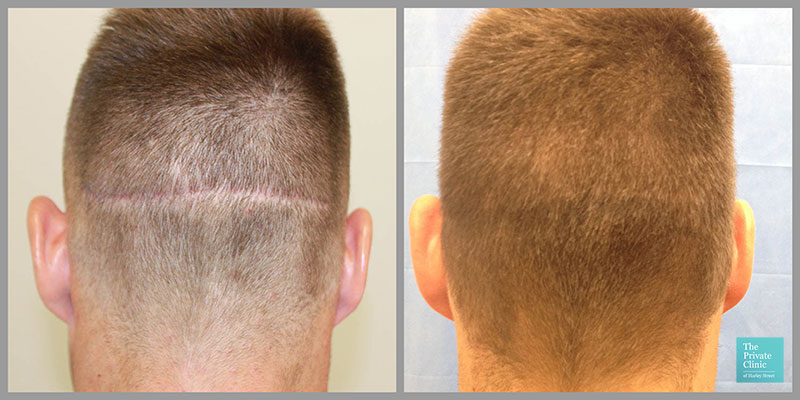 FUT Hair Transplant Scars Repair Scarring Following Hair Transplant 