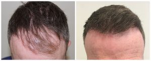 hair transplant hairline before and after photo results