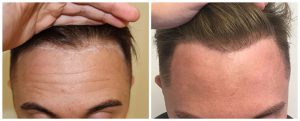 fue hair transplant surgery hairline results before after