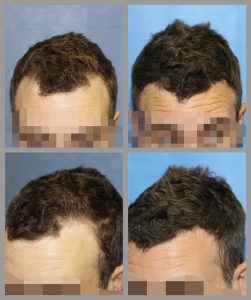 fue hair transplant temples hairline area 890 graft before after photos