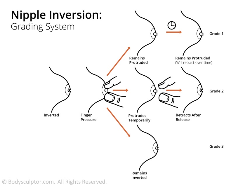 Inverted Nipple Grades