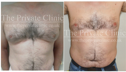 gynecomastia liposuction male chest reduction before after photo