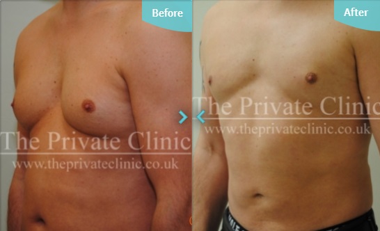 Before and after VASER treatment on the abdomen and for Male Breast Reduction at The Private Clinic.